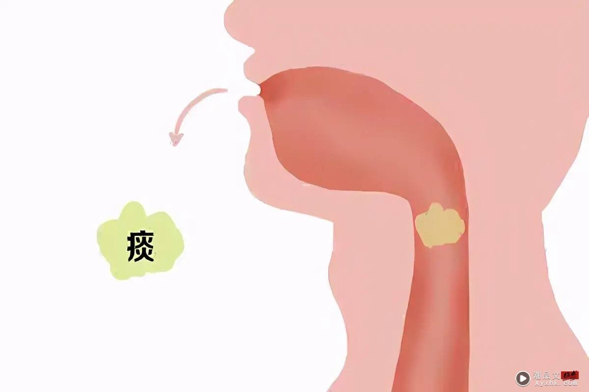 Tips I 喉咙有痰就是咳不出？4招协助咳痰无难度！ 更多热点 图1张